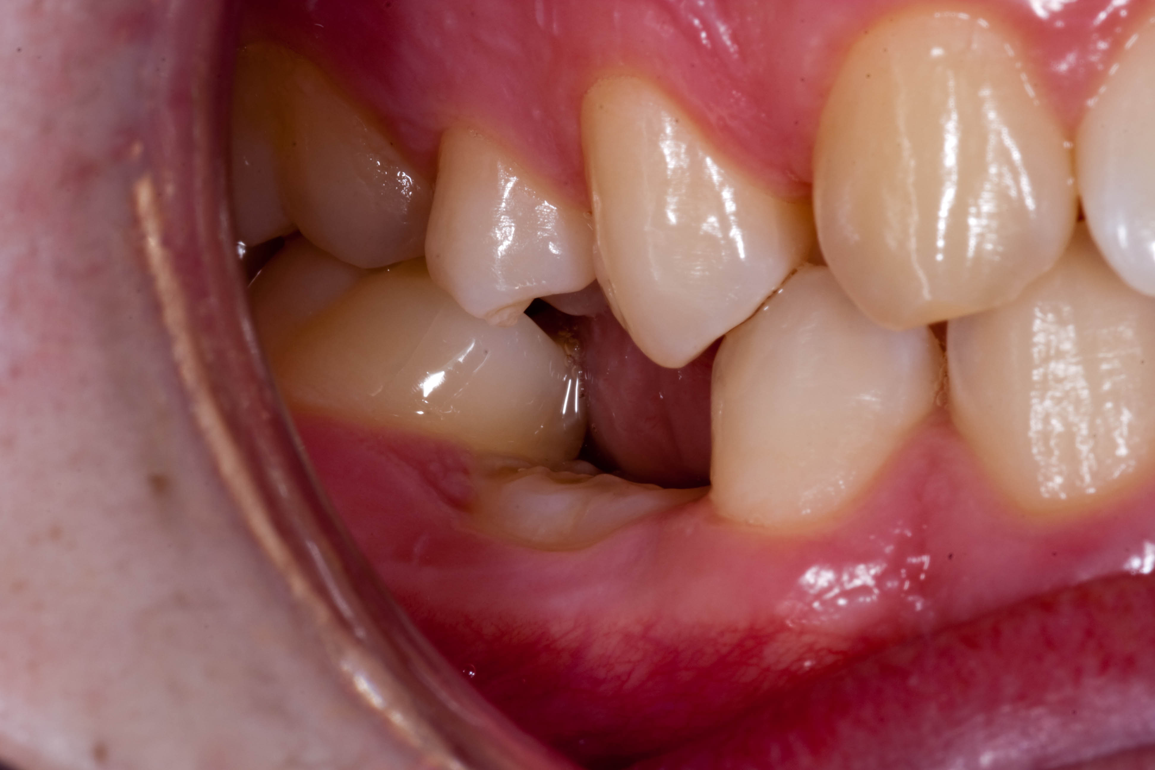 Adult Teeth 67