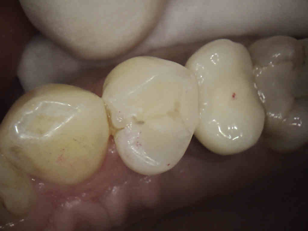 A hole in a tooth is a serious nuisance 33 A hole in a tooth is a serious nuisance 61
