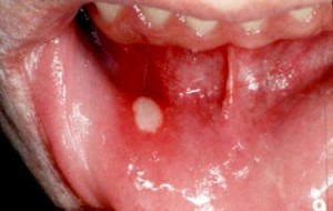 Type Of Oral Cancer