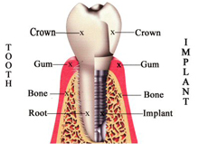 implants