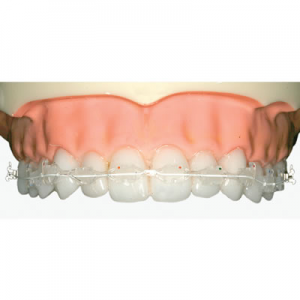 cfast Orthodontic braces with clear brackets and tooth coloured wires