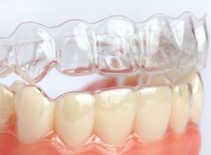 Clear Aligners - invisible braces