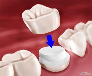 Dental crowns