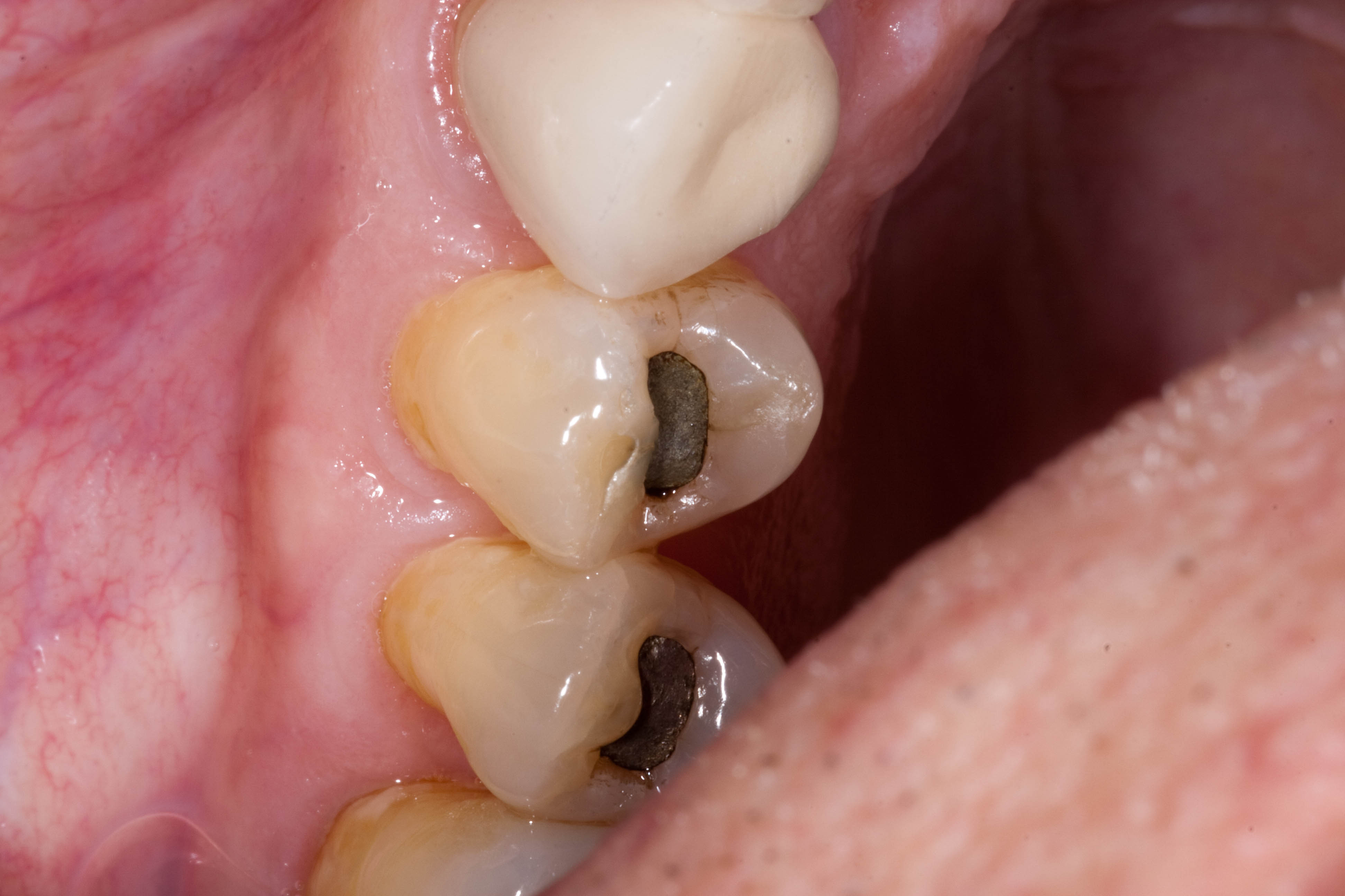 "Changing black fillings to tooth coloured ones" Blue Court Dental