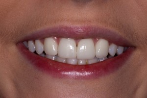 a review of treatment after dental veneers