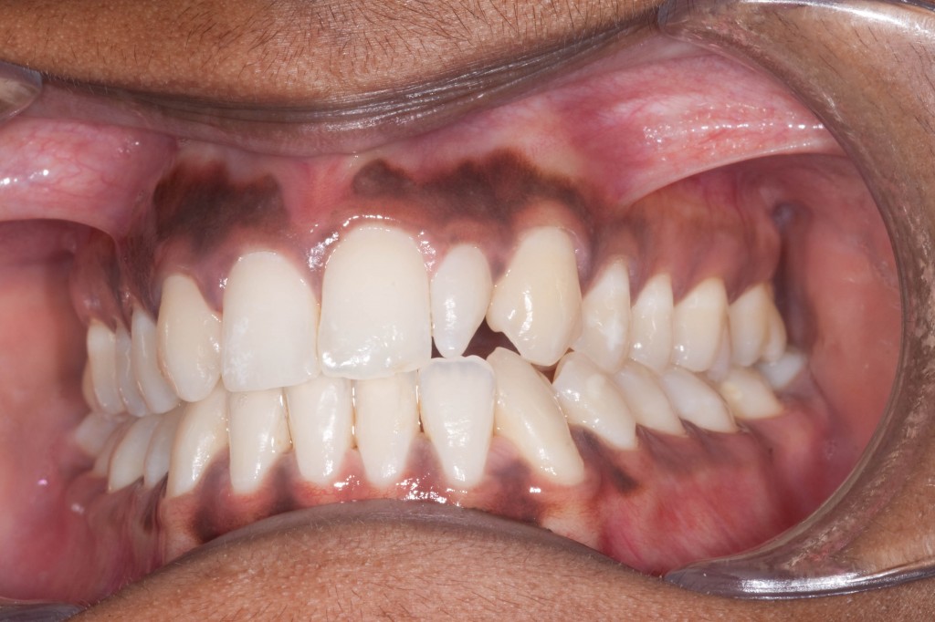 My tooth looks like a clothes peg! Can you help me? Blue Court Dental