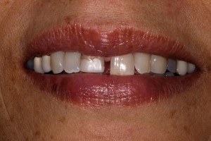 Before cosmetic dentistry from our Harrow dentists