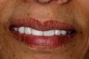 After cosmetic dentistry