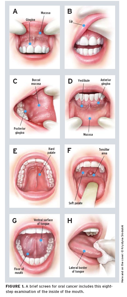 Oral Cancer Beauty Dental
