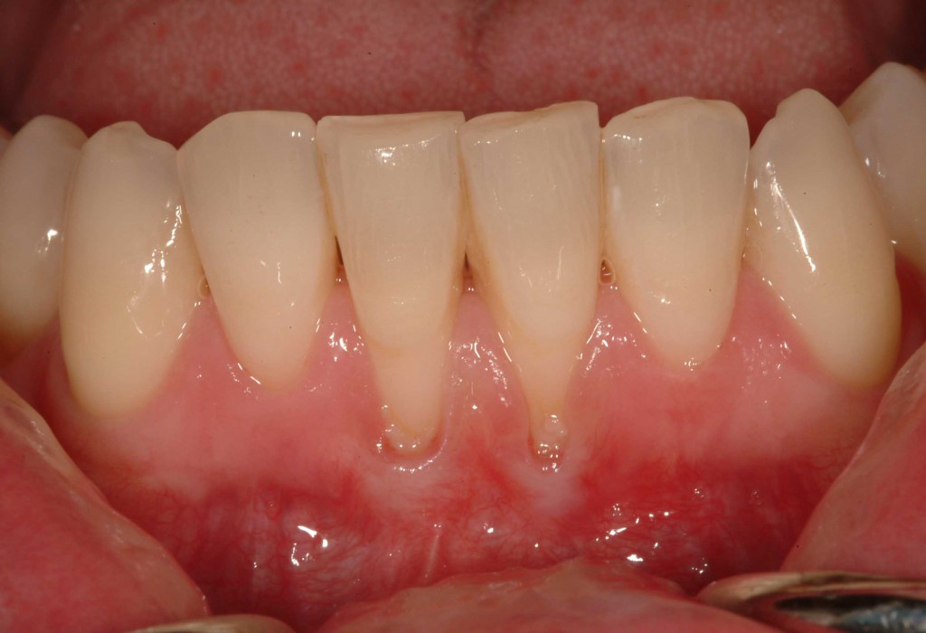 Image Credit: www.implantdentist.co.nz/procedures/gum-regeneration/