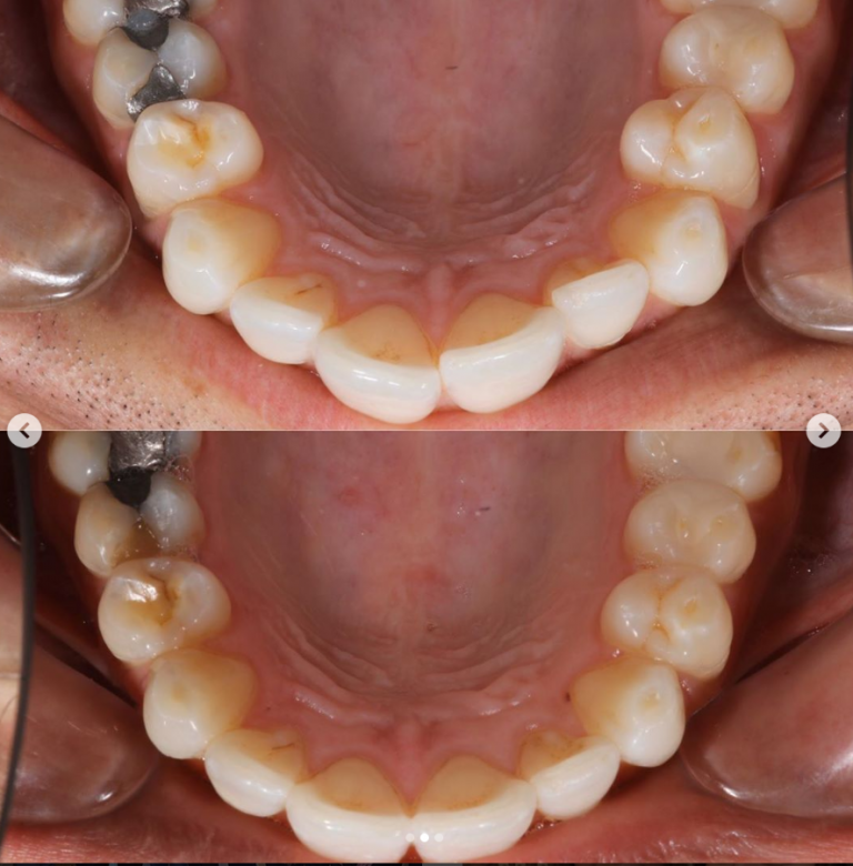 invisalign harrow overbite