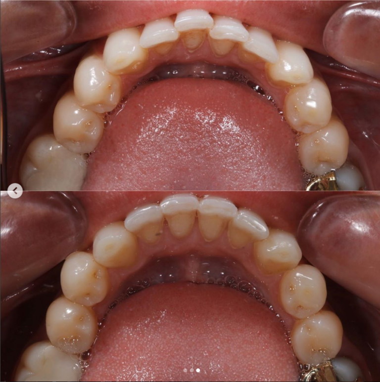 How long does Invisalign take? | Blue Court Dental Centre ...