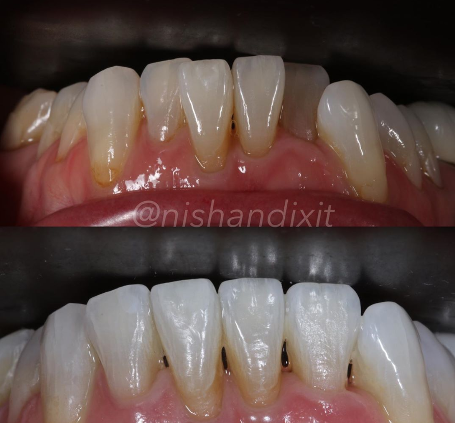 invisalign take does ideal harrow teeth correct treatment nishan dixit course dr