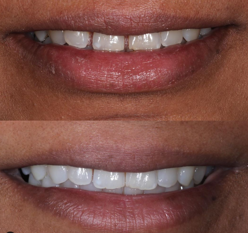 Invisalign results for closing the gap