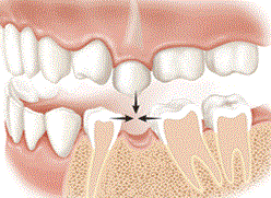 Teeth drifting without replacing the one lost