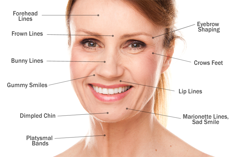 common treatment areas with Botox