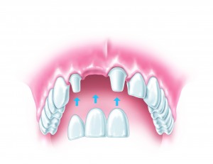 dental-bridge