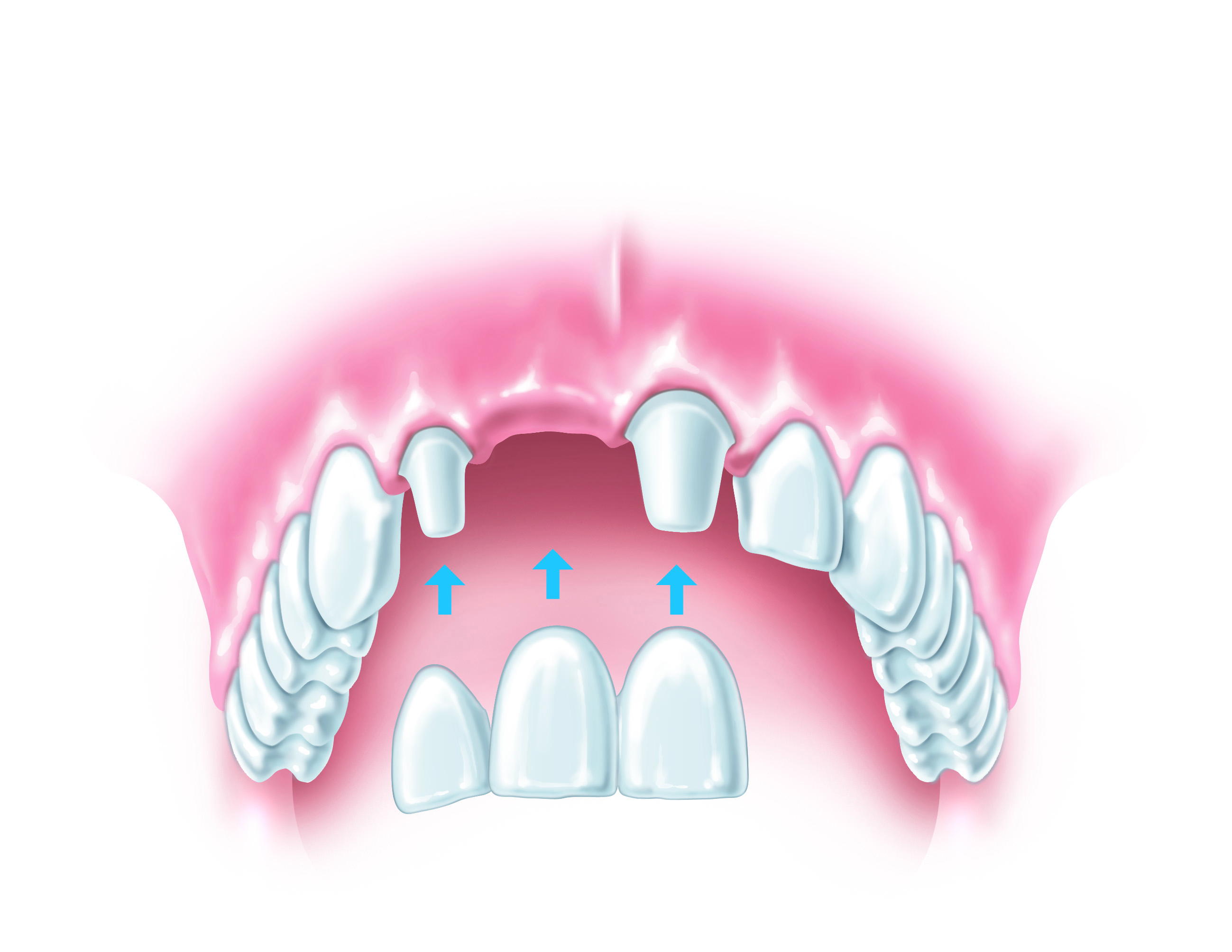 Best options to replace missing teeth