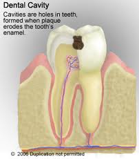 Formation of dental cavities