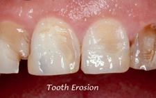 dental erosion