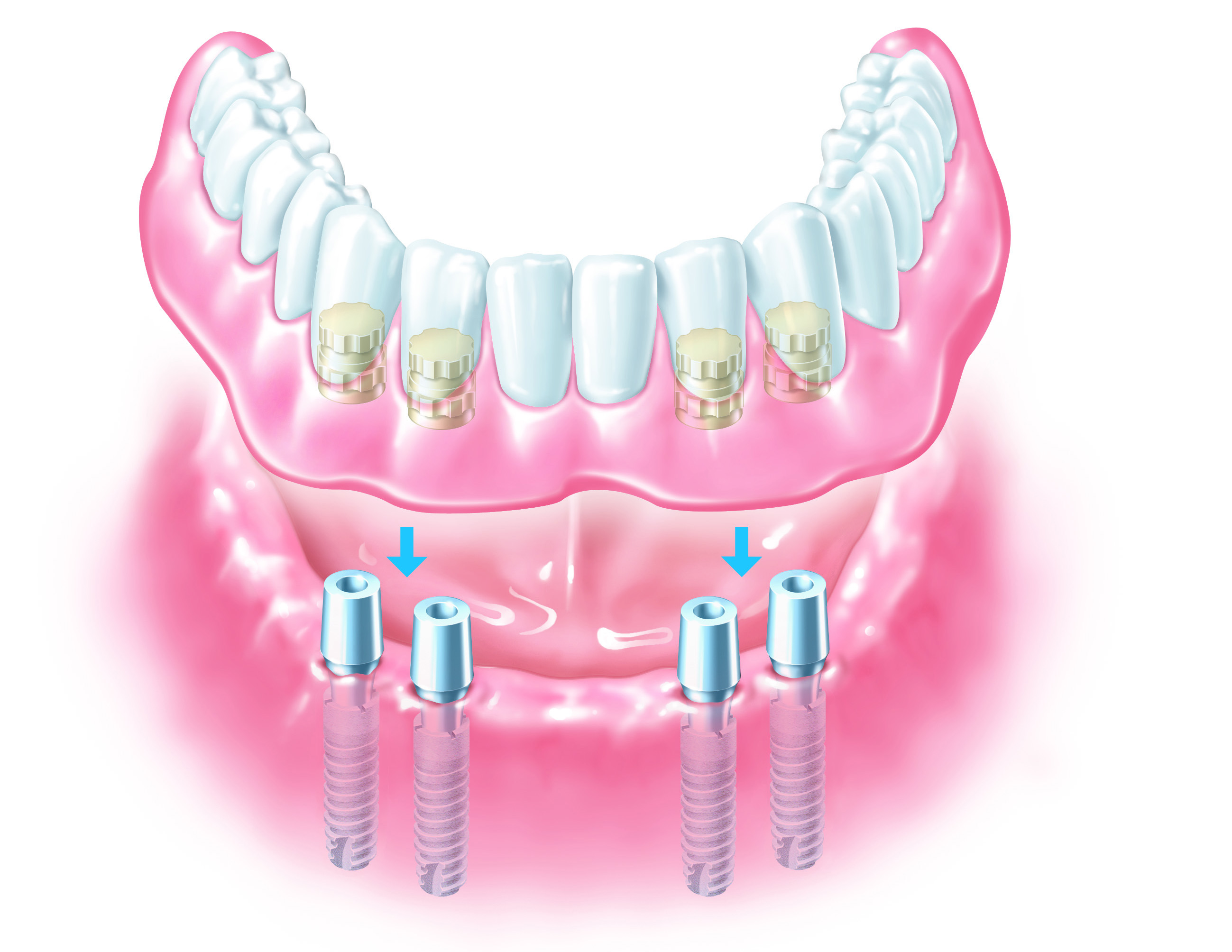 denture-implant