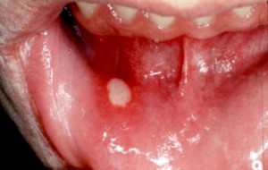 mouth ulcers