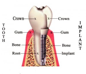 Dental implant versus natural tooth