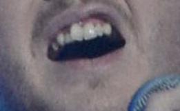 X factor winner James Arthur's teeth
