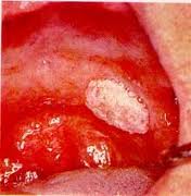 mouth cancer diagnosis