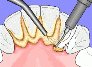 Plaque on teeth