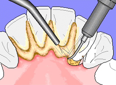  Plaque on teeth