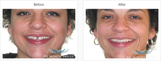 six month smiles adult braces