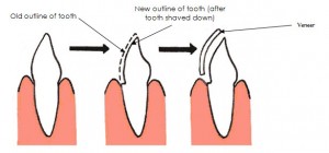 teeth-veneers