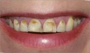 tooth erosion