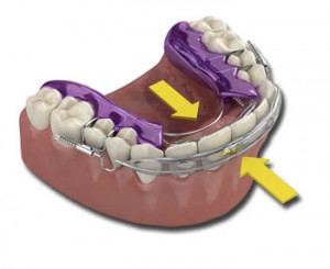 Inman aligner