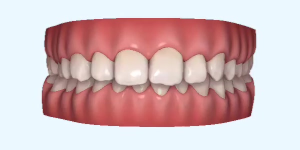 Invisalign Harrow - Blue Court Dental Centre