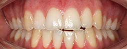 Invisalign Go