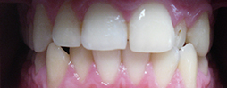 Invisalign Go