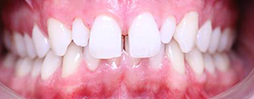 Invisalign Go