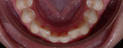 Invisalign Go