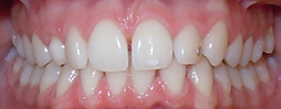 Invisalign Go