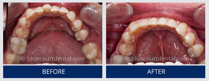 Inman Aligner Case