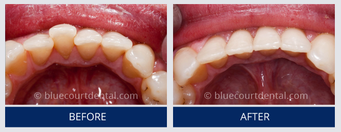 Inman Aligner Case