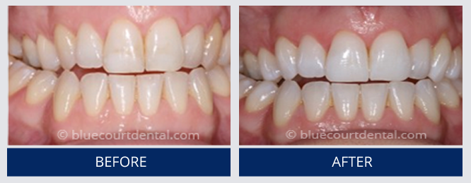 Whitening Case