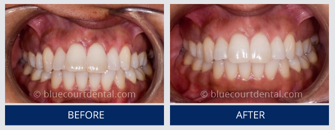 Inman Aligner Case