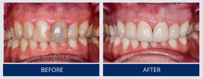 Mini Smile Makeover Case