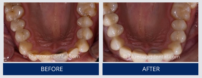 Mini Smile Makeover Case