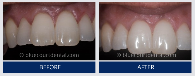 Inman Aligner Case