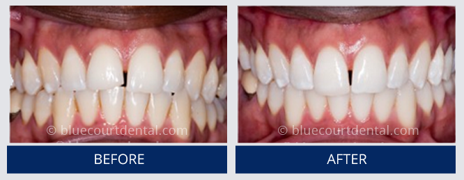 Composite Bonding Case