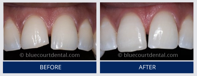 Composite Bonding Case